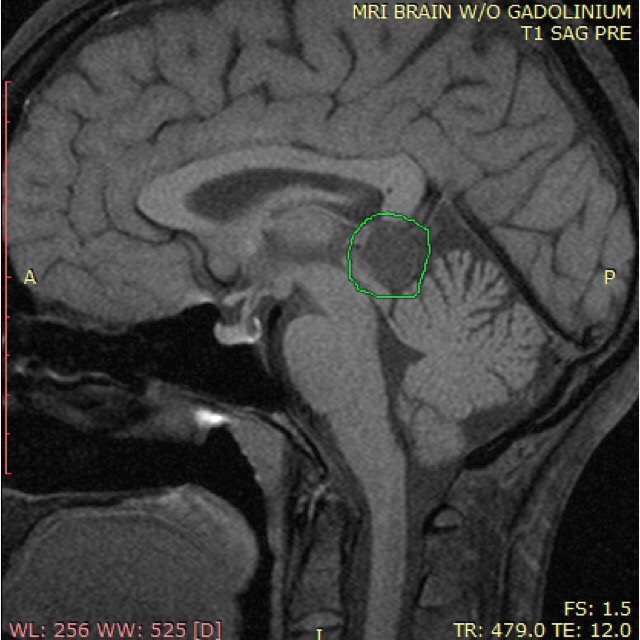 brain MRI cyst